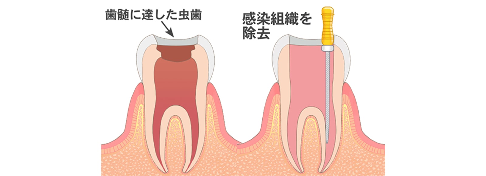 歯の神経を取る(抜髄)1