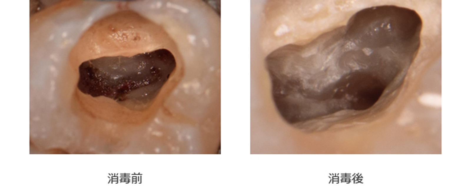 歯の神経を取る（抜髄）3