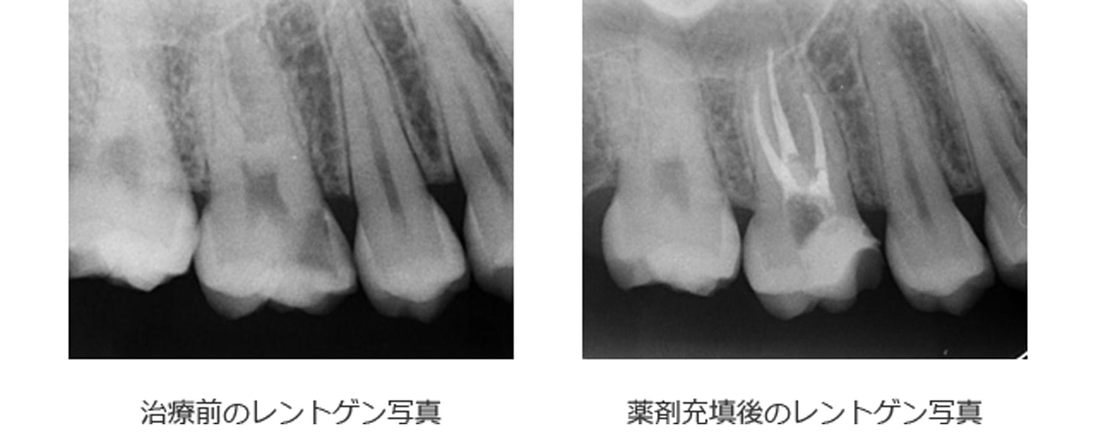 歯の神経を取る(抜髄)4