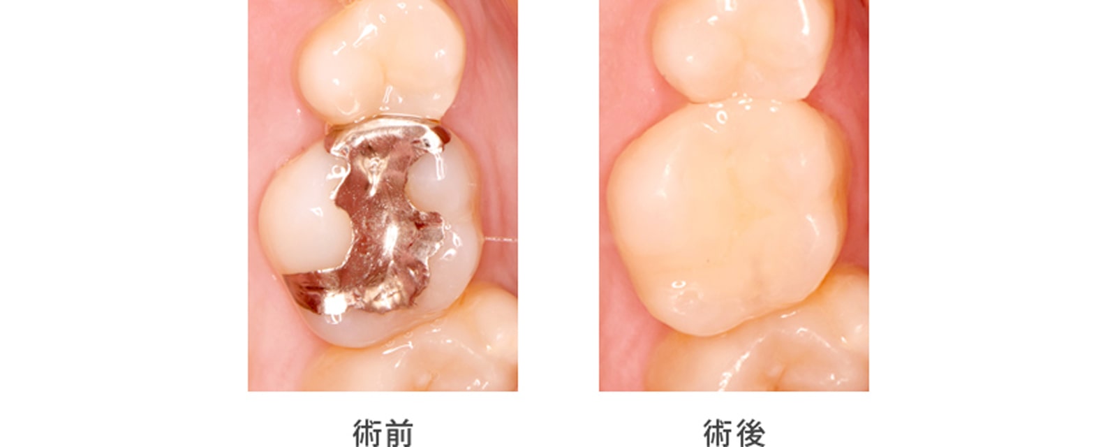 奥歯の銀歯を白い詰め物に変えたい