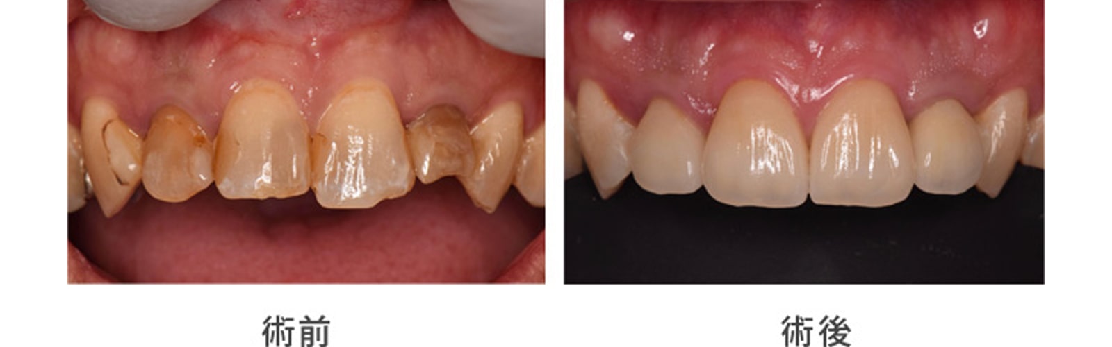 セラミックを用いて前歯を綺麗にする方法