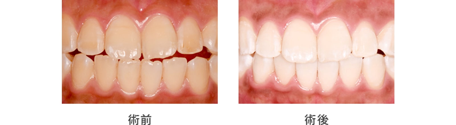 全体的に歯を白くしたい（ホワイトニング）1