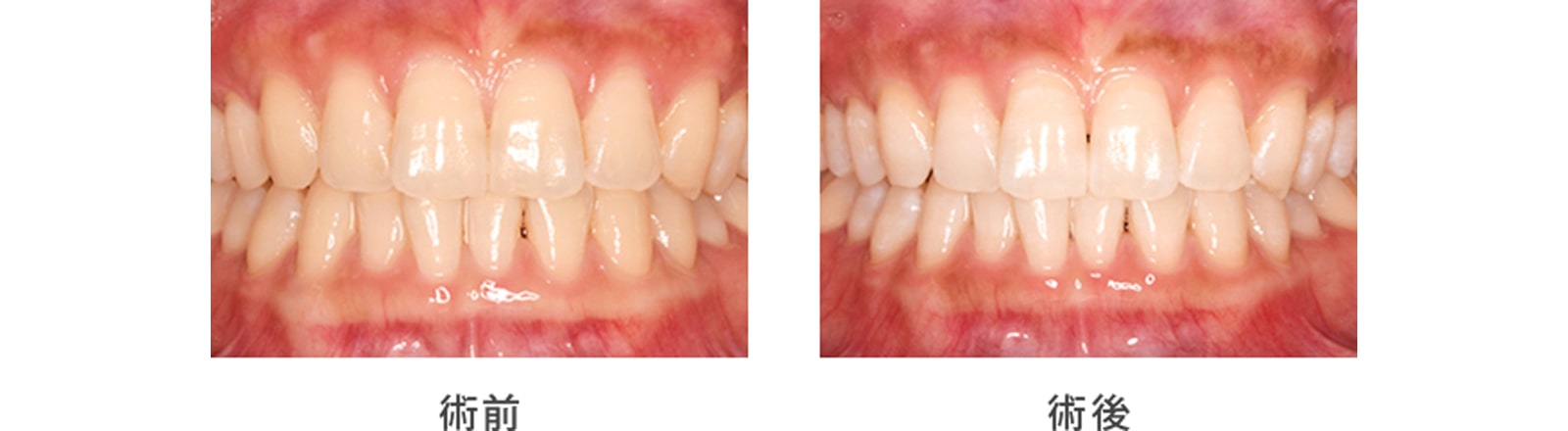 全体的に歯を白くしたい（ホワイトニング）2
