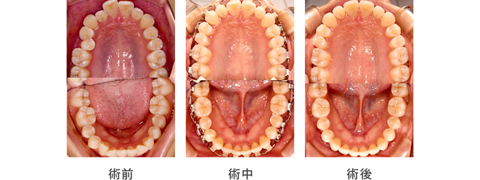 歯並びを綺麗にしたい1