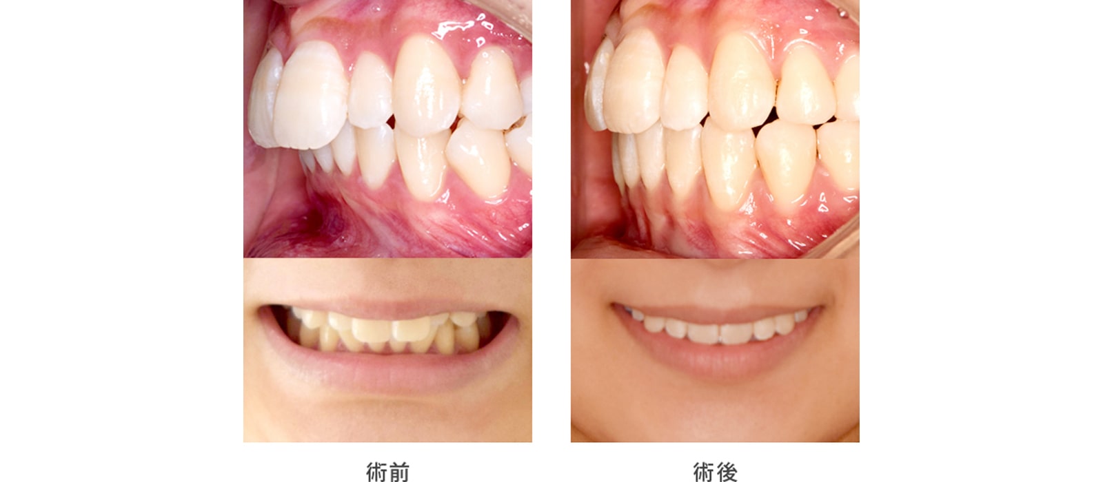 歯並びを綺麗にしたい2
