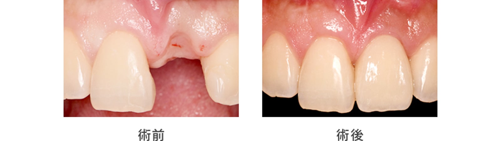 失った歯を回復したい