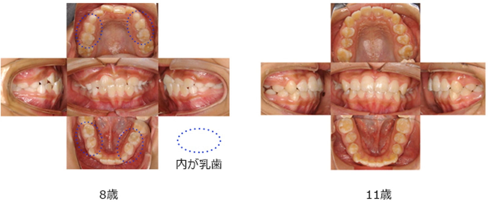 成長に合わせた矯正治療