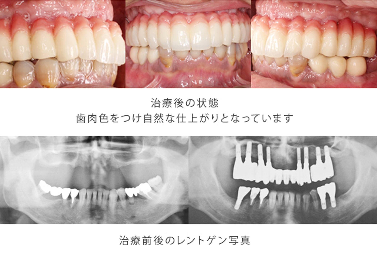 機能性と審美性と清掃性を兼ね備えた固定性の歯の装着