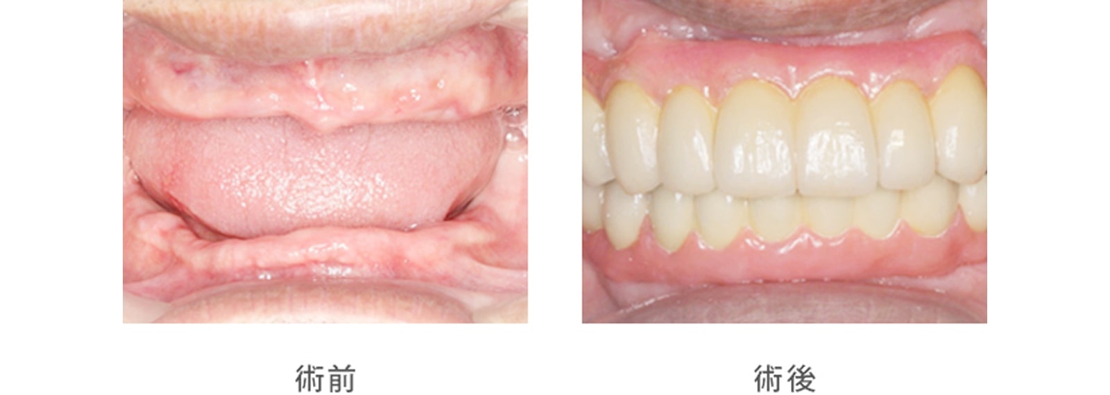 長年、上下の総入れ歯で悩まれていた患者様