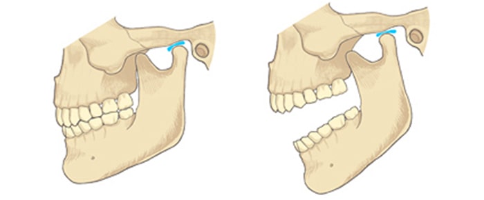 顎関節症の対応