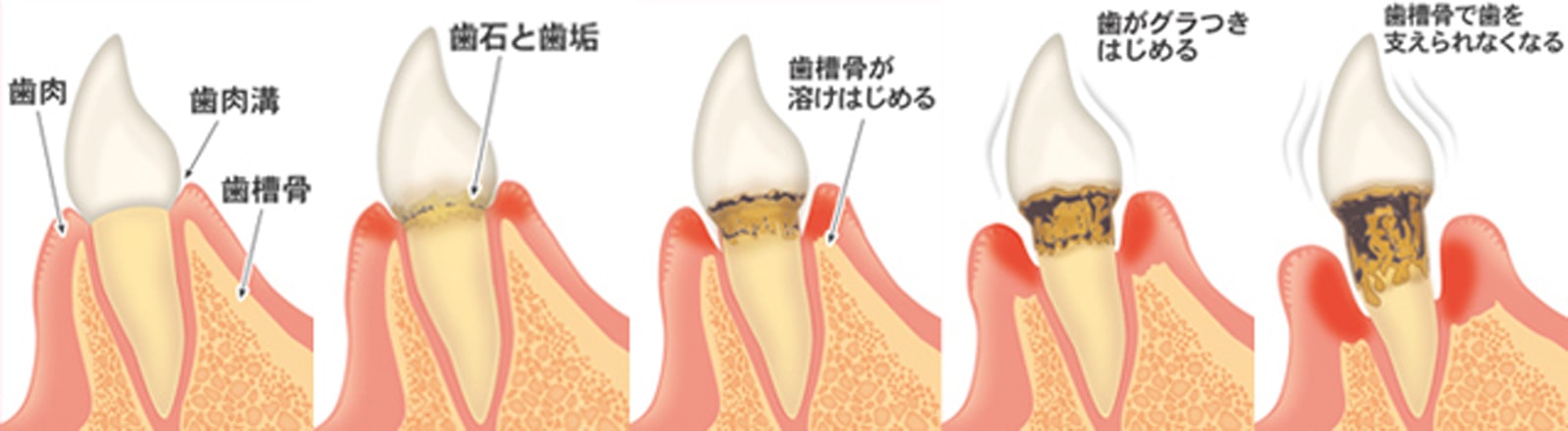 歯周病とは