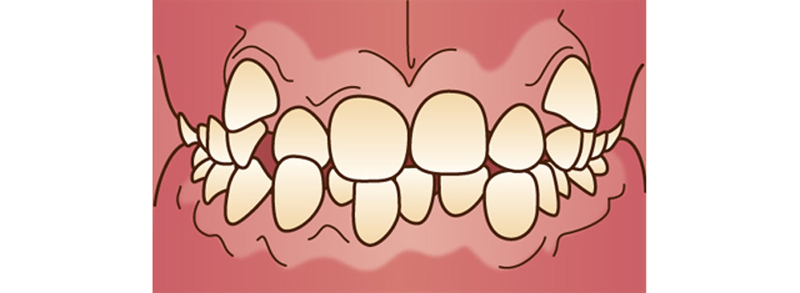 歯並び、噛み合わせ