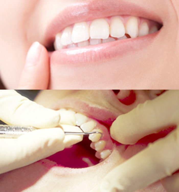 歯周病の治療原理