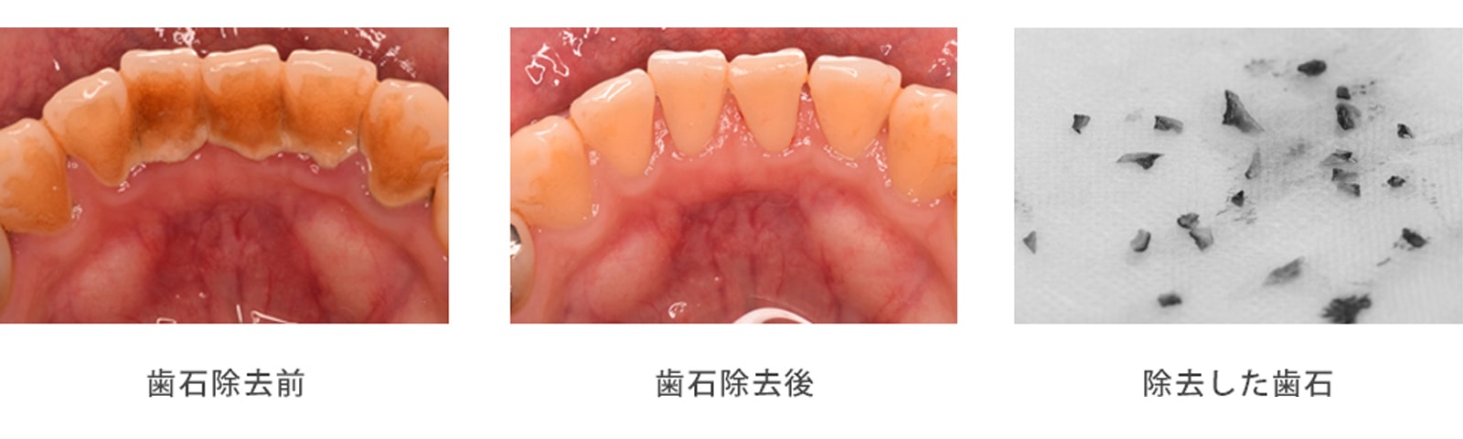 歯石除去1