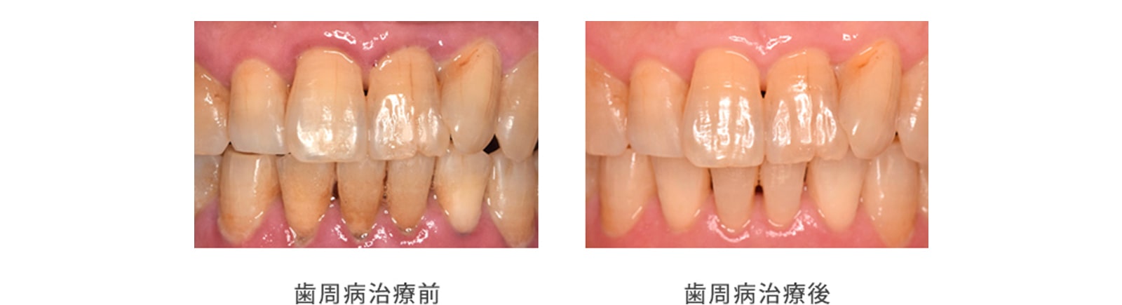 歯石除去2