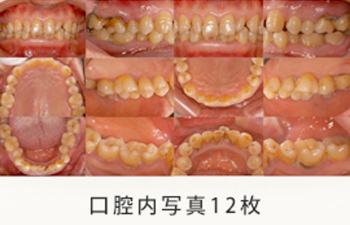 口腔内写真
