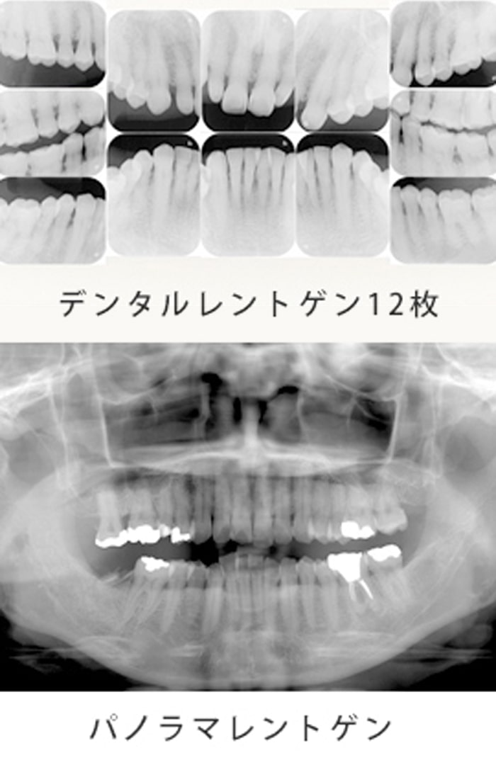 レントゲン